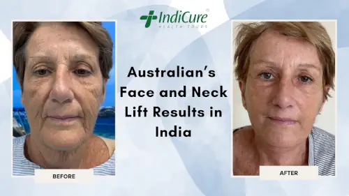 Australian's Face and Neck Lift Results in India